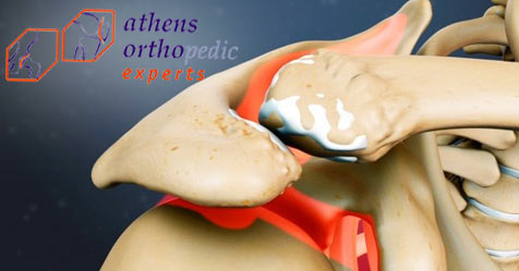 οστεοαρθριτιδα ωμου