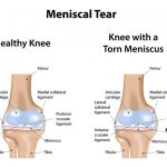 επέμβαση ρήξης μηνίσκου