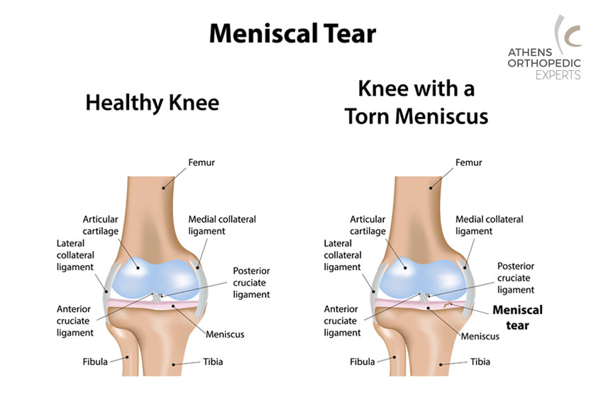 Συρραφή Μηνίσκου