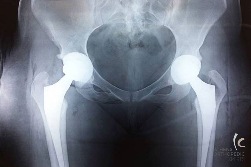 ταυτοχρονη ολικη αρθροπλαστικη